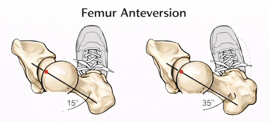 Femur antetorsio gyerekeknél