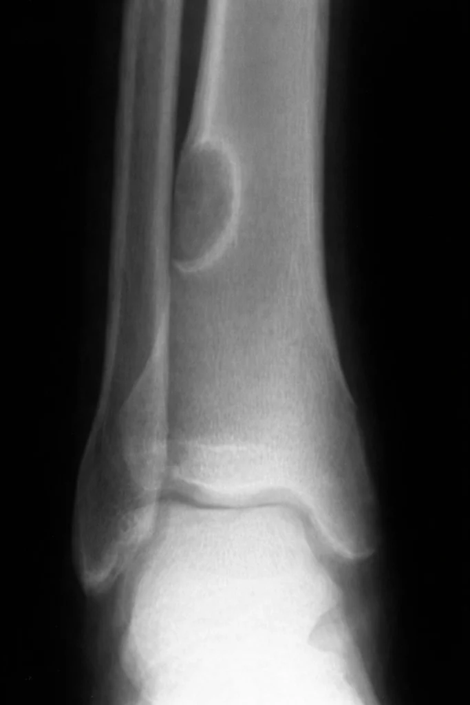 nem osszifikálódó csontfibroma